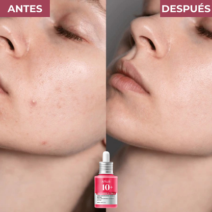 Serum Anti-manchas de Alta Potencia