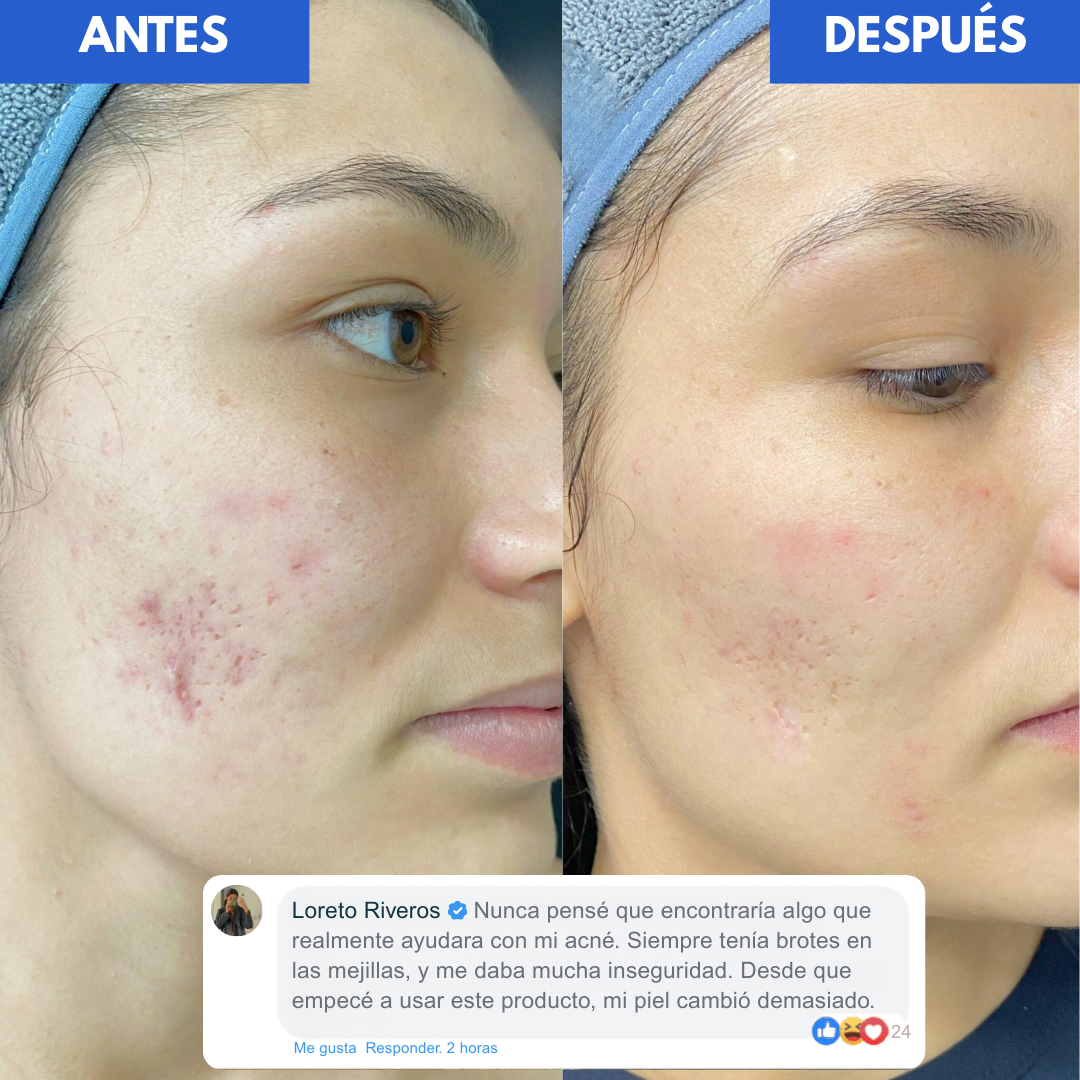 Tratamiento Secante Antiacné - Dr. Leo