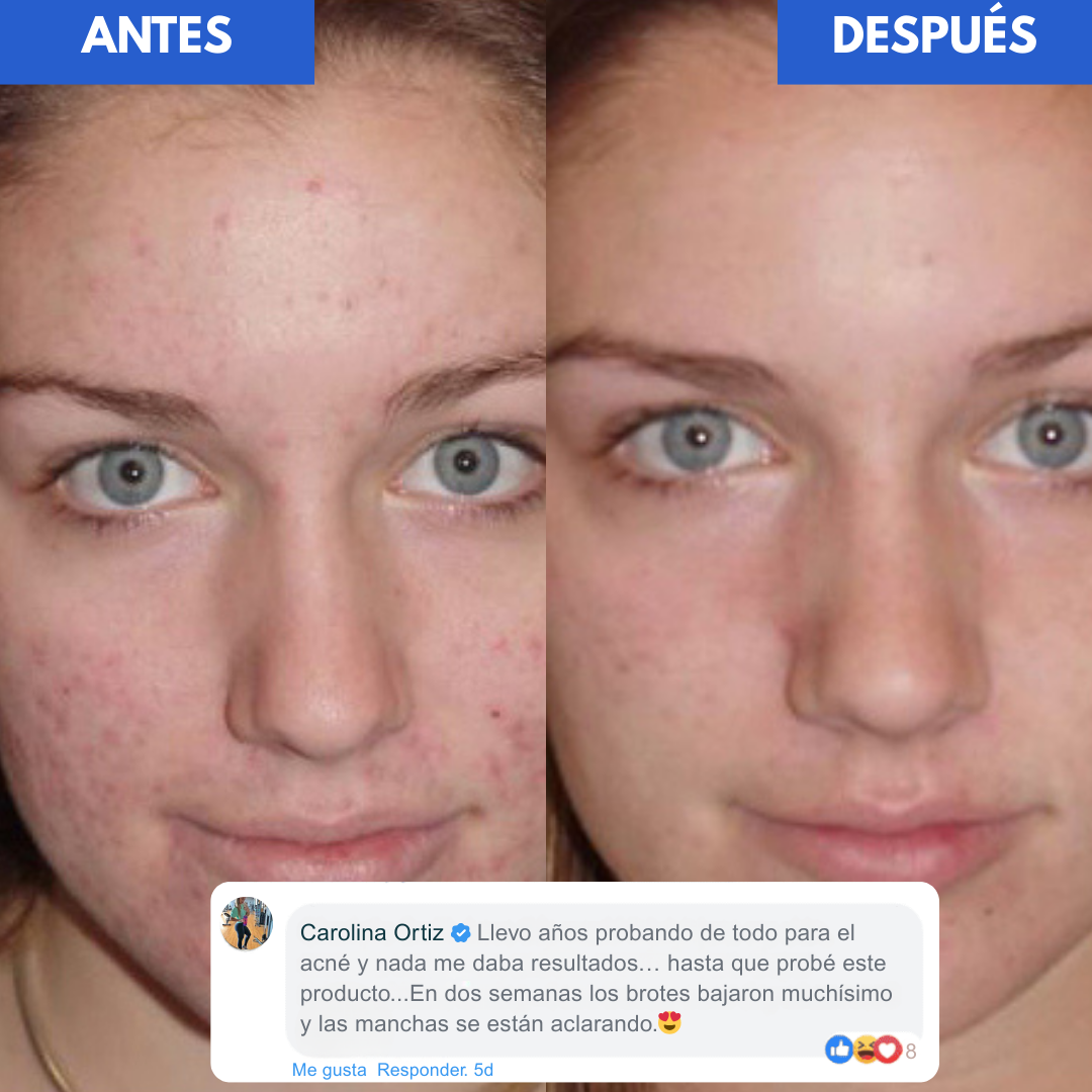 Tratamiento Secante Antiacné - Dr. Leo