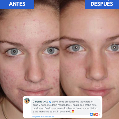 Tratamiento Secante Antiacné - Dr. Leo